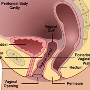 Hysterectomy2
