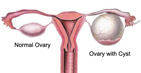 Ovarian-cyst-treatment-India