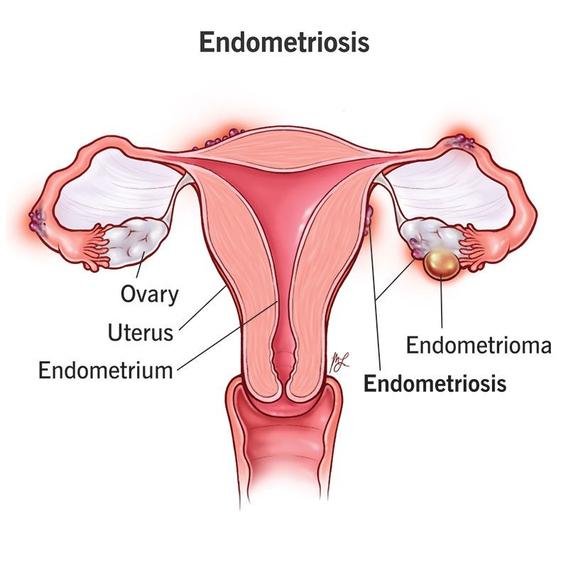 Endometriosis
