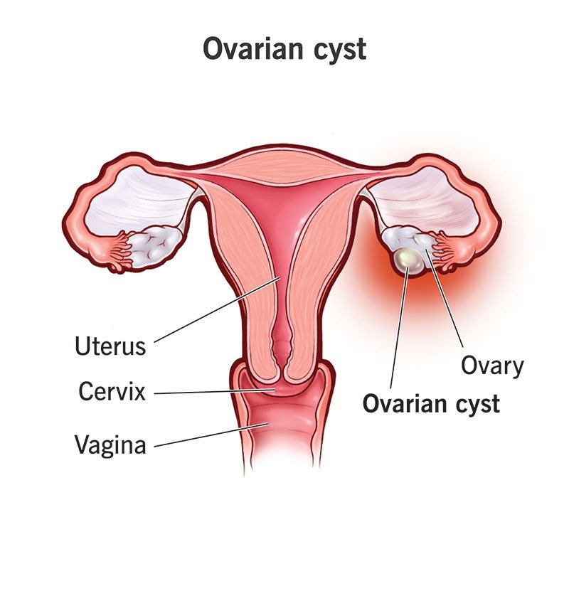 Ovarian Cysts