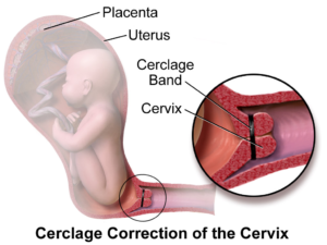 Laparoscopic correction of cervical incompetence
