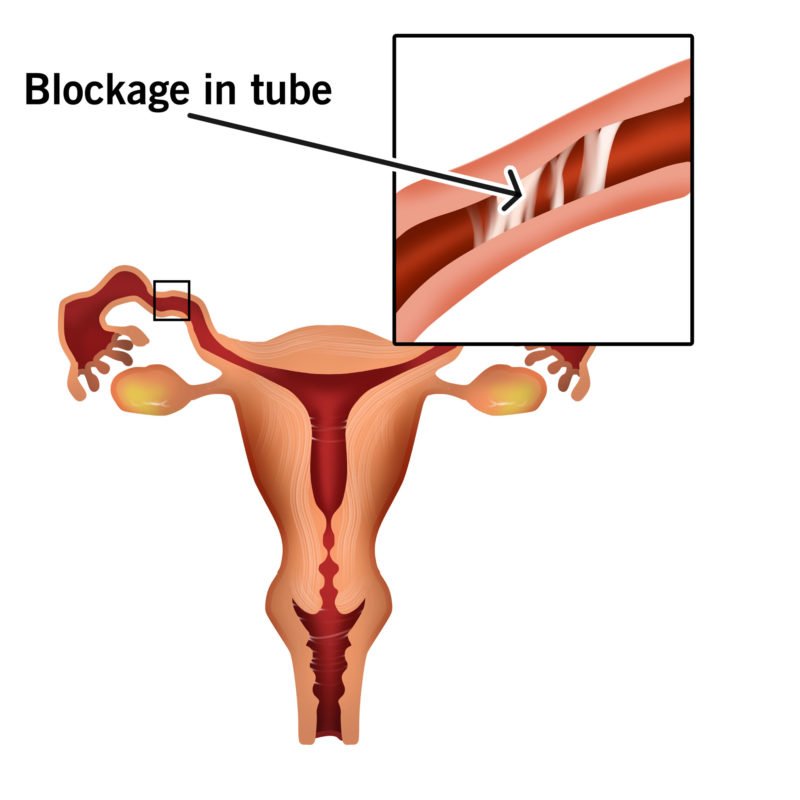 Tubal Problems and Infertility