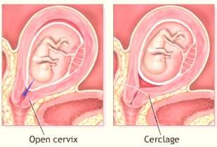 Laparoscopic correction of cervical incompetence